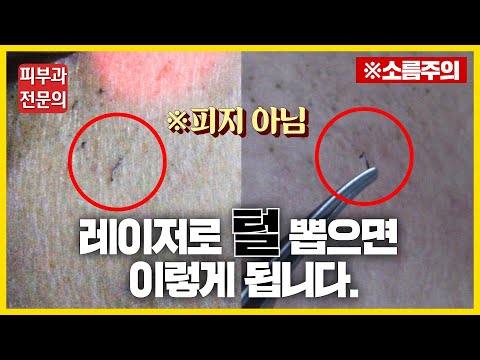 레이저 제모 1회차는 효과가 어느 정도 일까? 실제 영구제모 시술과정, 경과 공개!