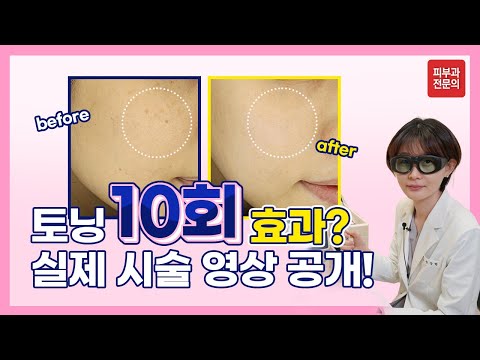 레이저토닝, 10회만에 잡티가 사라질까? -토닝 10회 후기, 실제 시술영상 공개