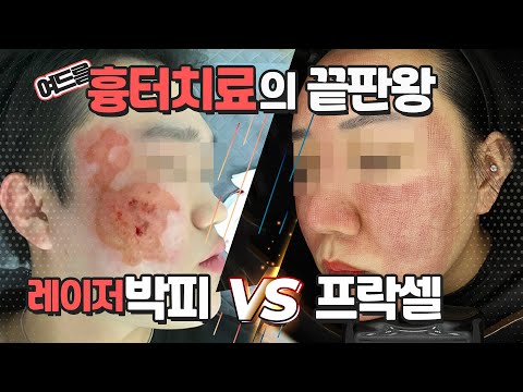 여드름흉터원정대 15탄. 여드름흉터 치료의 끝판왕. 레이저박피 Vs 프락셀