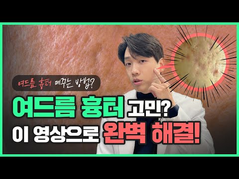 여드름 패인 흉터도 없앨 수 있을까?｜강남 피부과 원장이 다 알려줍니다!