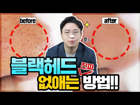 (ENG) 블랙헤드 없애는 방법!👃🏻