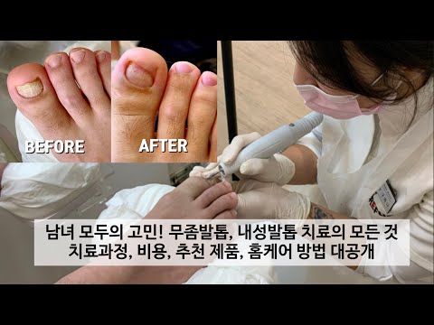 발톱 스케일링, 발톱 관리에 대한 가장 자세한 설명 영상 / 질문 댓글 답변드려요 / FOOT SCALING / athlete's foot / 레푸스 / REFUSS / 발톱무좀