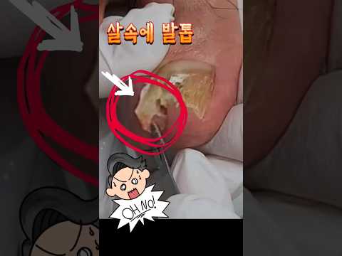 (소리주의)살 속에 파묻혀 있는 발톱😭 시원하게 제거하기 #내성발톱 #ingrowntoenail #동작구 #장승배기 #노량진 #레푸스 #레푸스상도 #조원장의풋솔루션