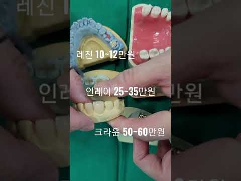 치과 치료 종류/ 비용 ( 54초면 끝 ) / 레진 인레이 크라운