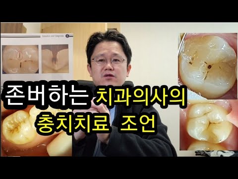 폭망한 치과의사의  초기 충치 치료  주의할 점