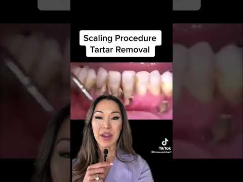 Scaling Procedure Tartar Removal #shorts