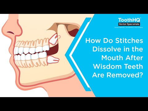 How do stitches dissolve in the mouth after wisdom teeth are removed?