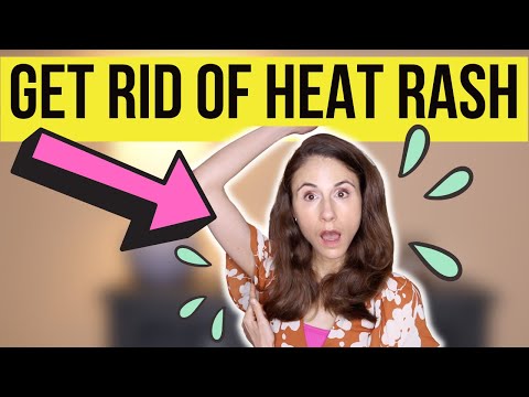 HOW TO GET RID OF HEAT RASH FAST! Dermatologist @DrDrayzday