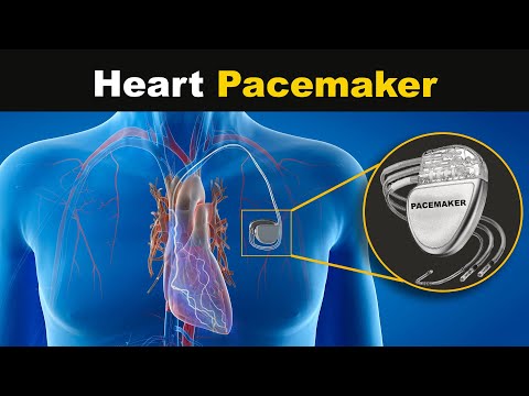 How Heart Pacemaker works? (Urdu/Hindi)